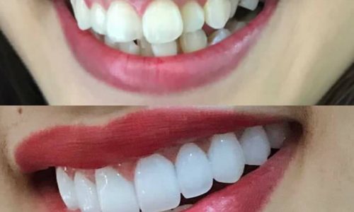 Răng khấp khểnh có bọc sứ được không